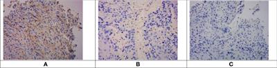 Pre-immunotherapy radiotherapy enhanced the efficacy of multi-line sintilimab in unresectable advanced esophageal squamous cell carcinoma